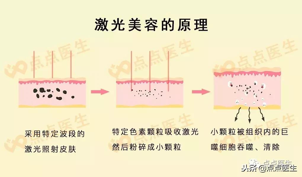 抗衰一定要用医美吗,什么激光抗衰好