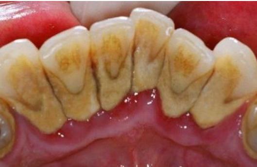 牙齿发黄变白小窍门,小孩牙齿发黄是什么原因如何去除