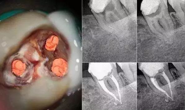 牙齿根管治疗全过程牙髓有个洞,牙髓一旦暴露就必须做根管治疗吗