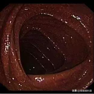 大肠变黑吃什么药好,大肠变黑便秘