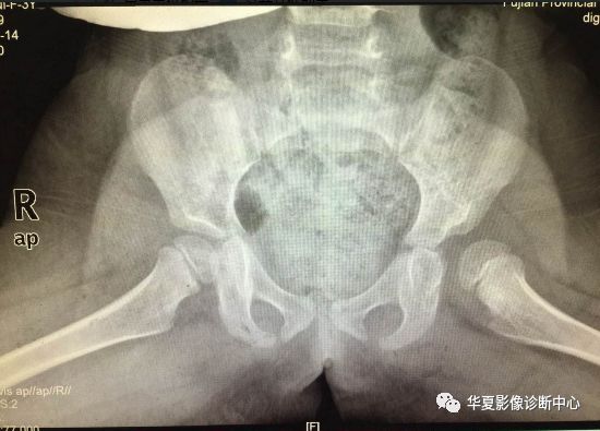 先天性髋关节脱位饮食,先天性髋关节脱位属不属于残疾人