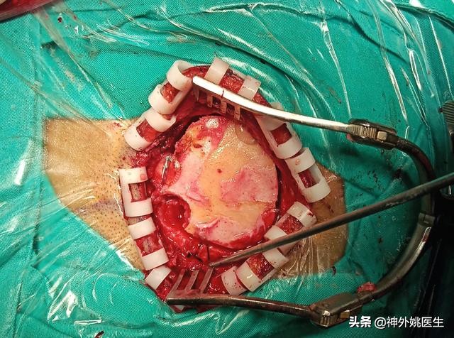 微创手术后血肿是什么,颅内血肿微创清除术多少钱