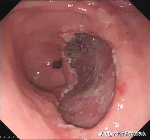 通过科普文章求治的一例胃窦后壁早癌