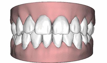 牙缝大是牙冠矫正还是贴面,牙齿贴面补牙缝多少钱