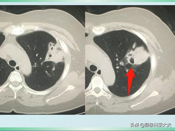 新冠肺炎对癌症有影响吗,癌症晚期肺炎怎么治疗