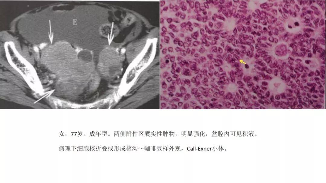 卵巢原发肿瘤的分析思路