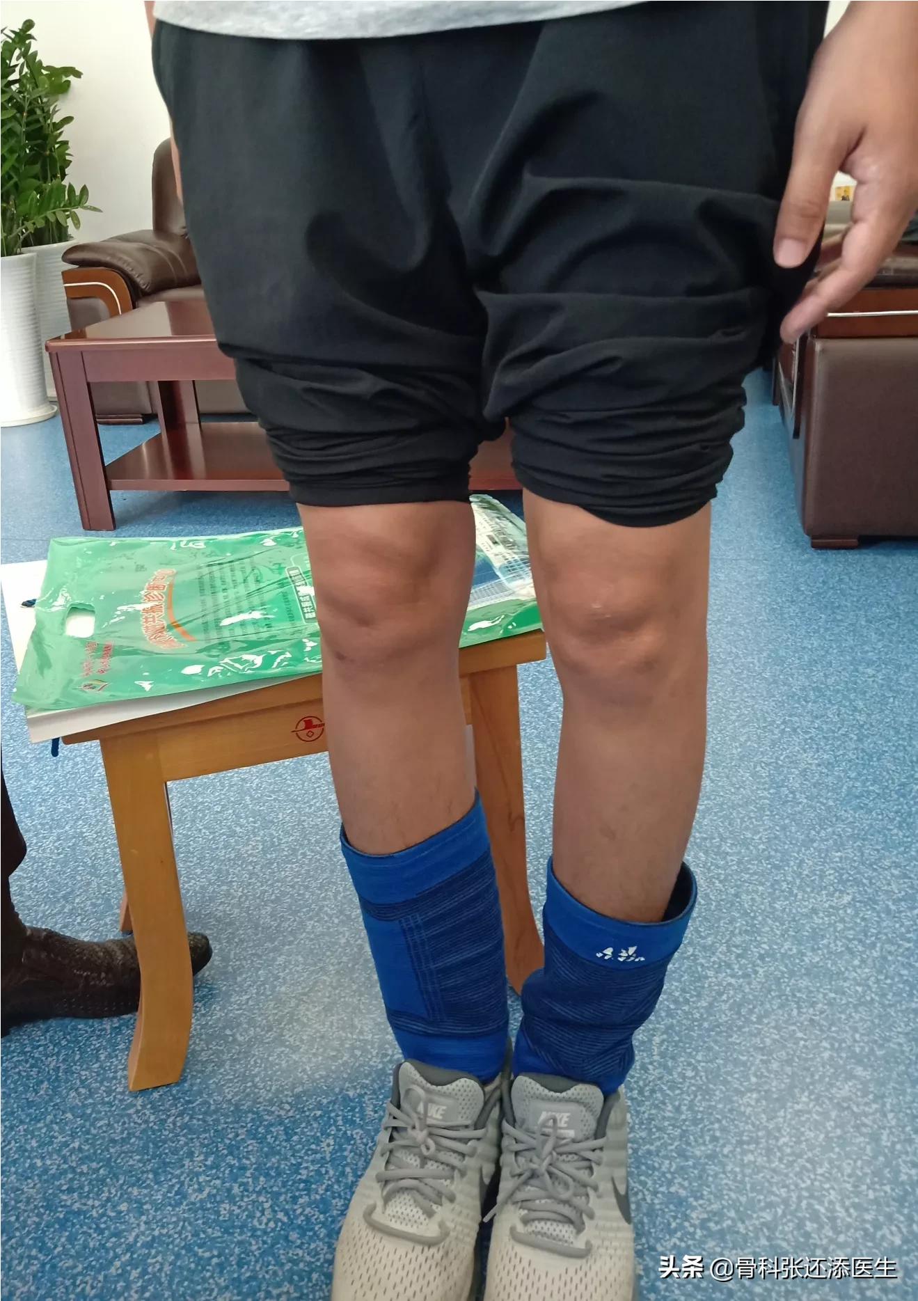 打篮球会导致o型腿加重吗,o型腿打篮球能纠正吗