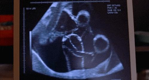 纠正胎位乾坤大挪移多少米,医生帮孕妇挪胎位