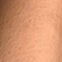 又到了穿小裙的季节，鸡皮女孩该怎么办……