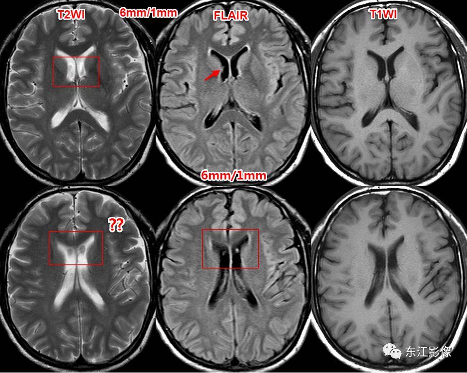 头颅mri扫描影像哪里找,头颅影像mra详细解说