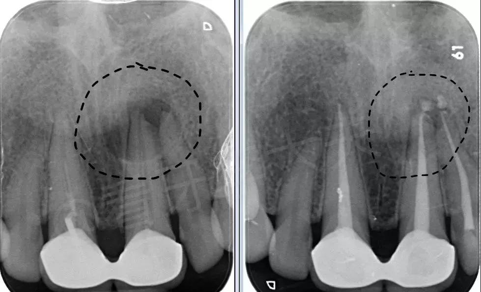 已经有牙洞了怎么根管治疗,牙髓腐烂坏死再做根管治疗会痛吗