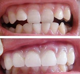 美牙冠改善龅牙,美牙冠可以修复缝隙吗