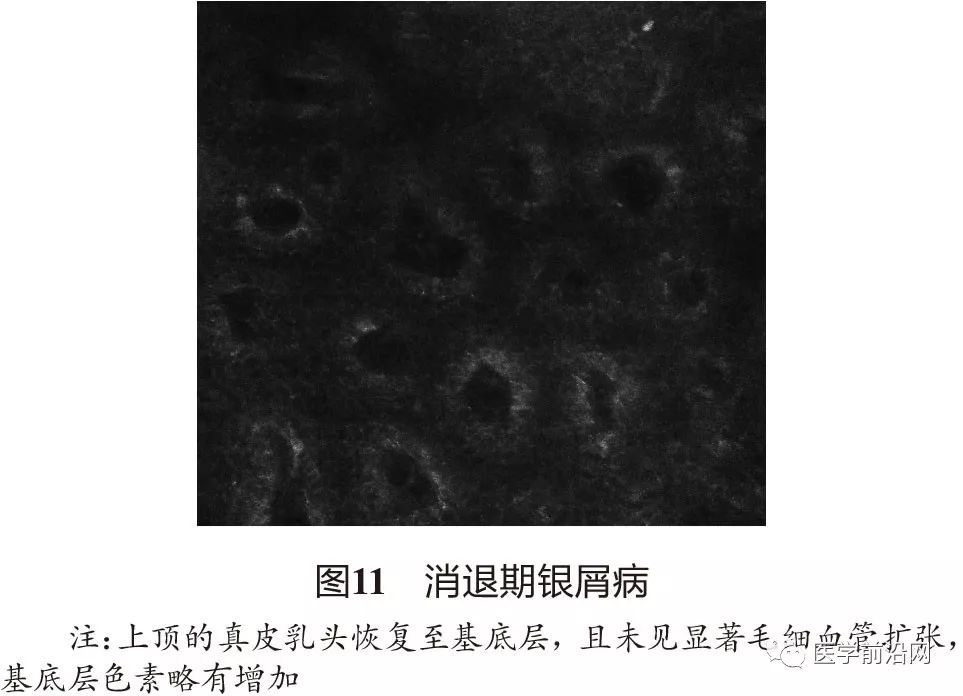 炎症性皮肤病反射式共聚焦显微镜诊断特征专家共识全文发布