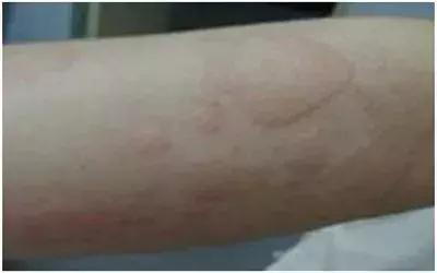 小儿麻疹两天疹子就没有了好不好,小孩荨麻疹最怕三个土方法