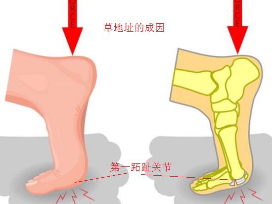 草地趾的症状,草地趾怎么康复
