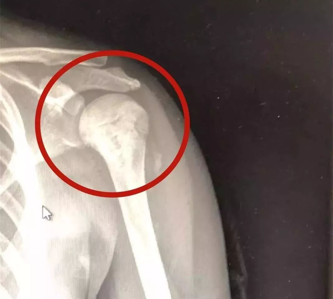 青少年骨癌疼痛特点,胳膊痛是骨癌的几率多大