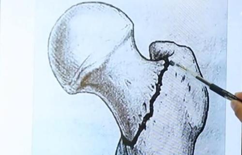 老年人肱骨骨折后该不该手术治疗,老人骨折的症状和治疗方法