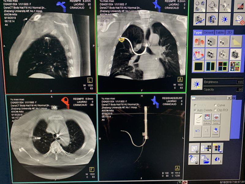 电磁导航微波消融肺结节费用,电磁跟踪手术导航仪
