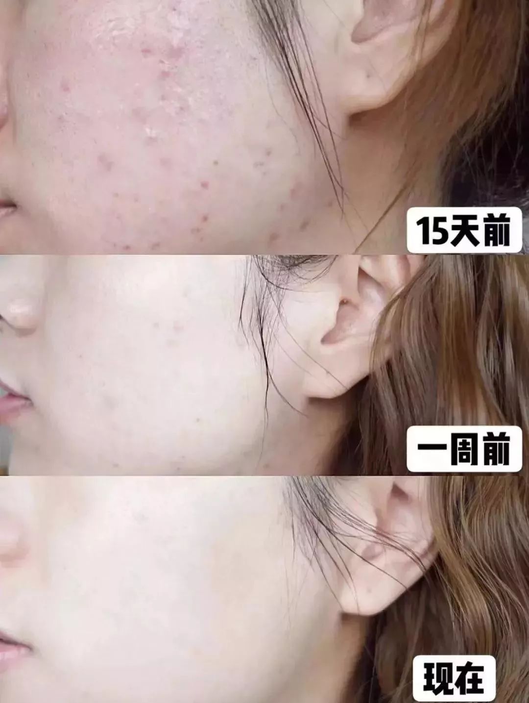 男生螨虫脸特征,螨虫脸的特征