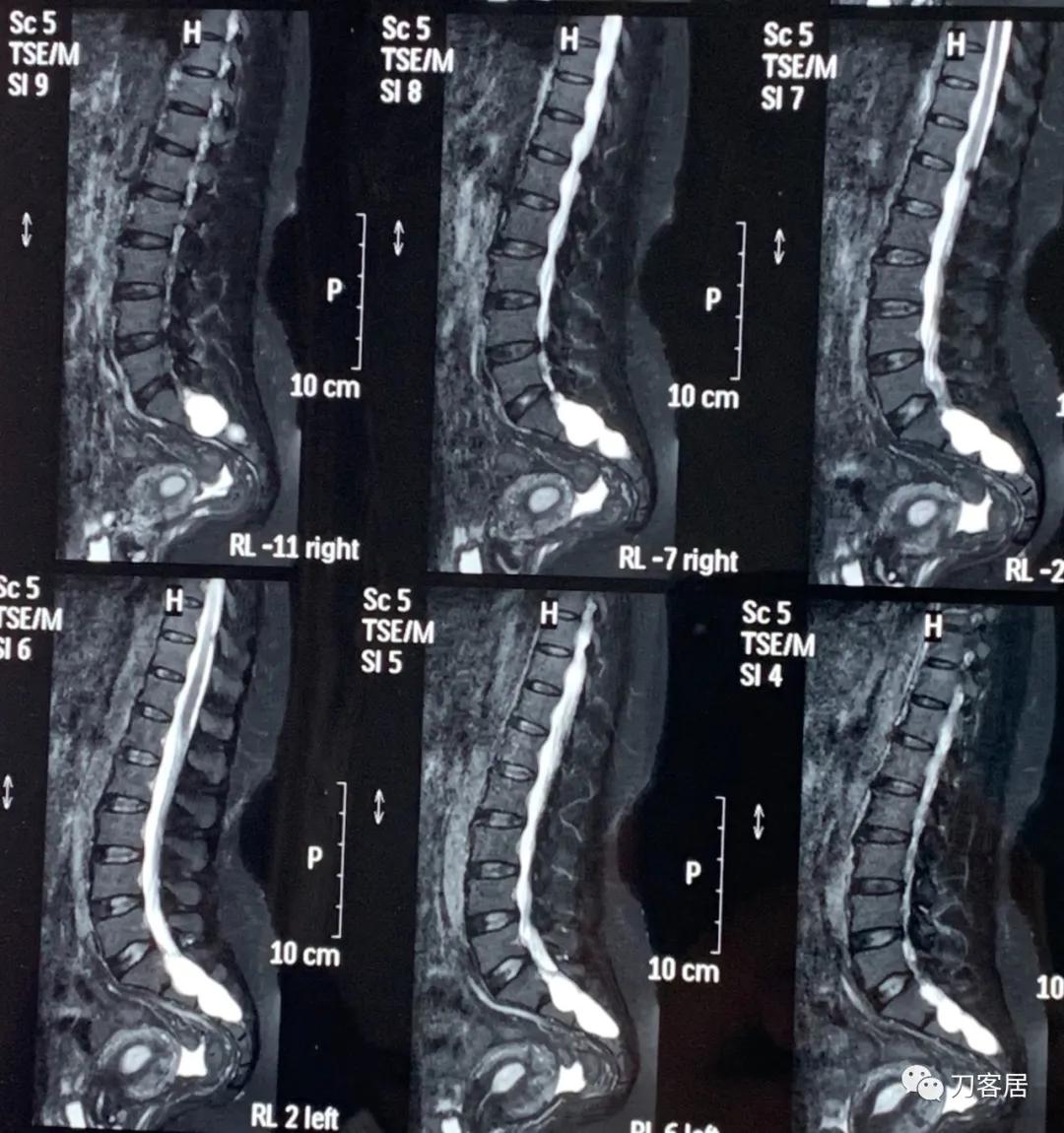 髋关节骶管囊肿,骶管囊肿手术后右腿还是疼咋回事