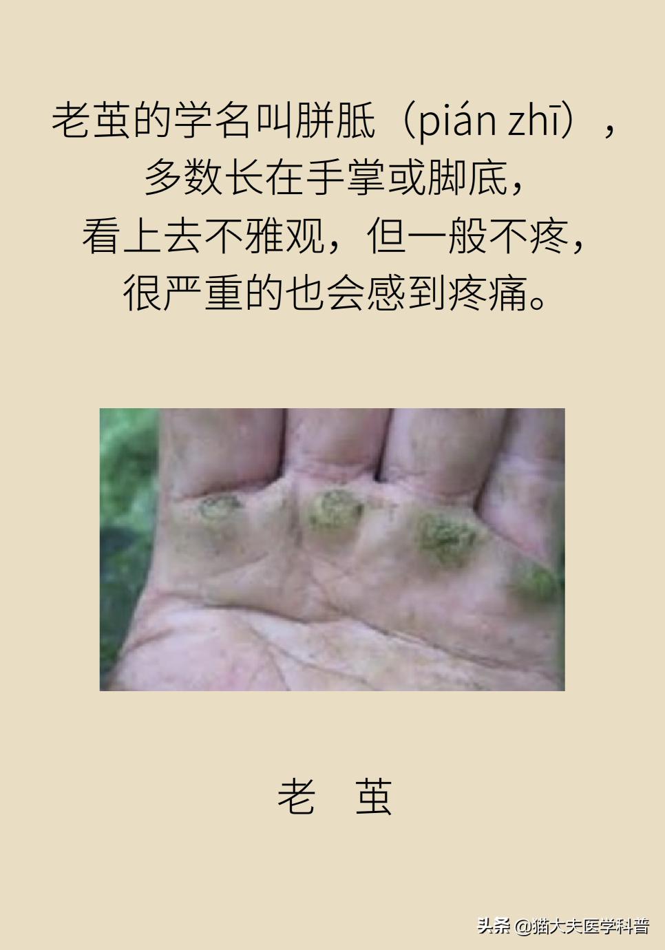 鸡眼好了长了一层老茧,鸡眼与老茧的区别图片