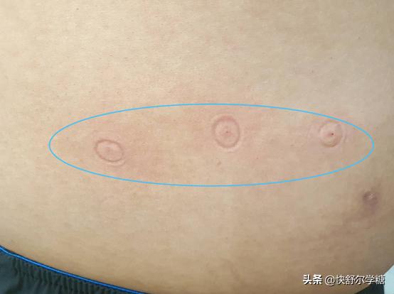 糖尿病注射胰岛素的器械在哪里买,糖尿病胰岛素无针注射器价格表