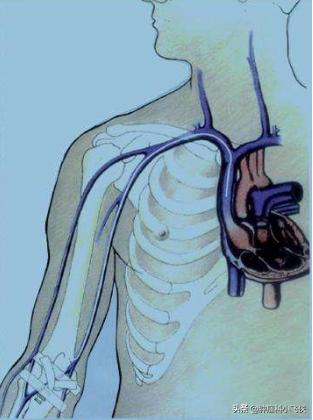 化疗埋管保证治疗顺利进行,一旦药物外渗患者遭罪又耽误治疗