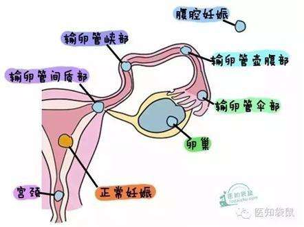 年纪大比较容易宫外孕,大学意外宫外孕