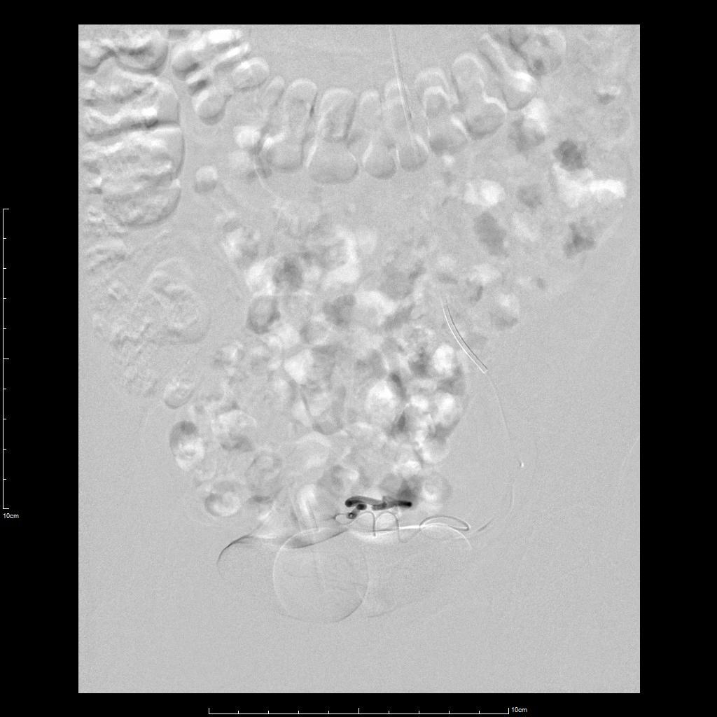 囊性子宫腺肌病的特点是什么,囊性腺肌病最佳治疗方案