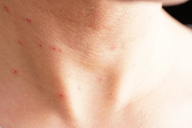 点阵激光是什么,up点阵激光和ap点阵激光