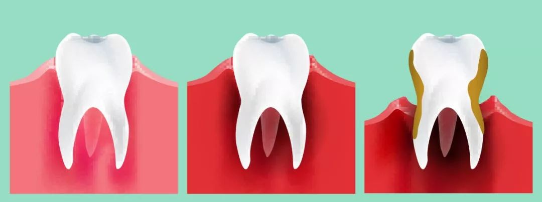 上火牙齿松动一咬就疼吃什么药,上火牙齿松动发软用什么药