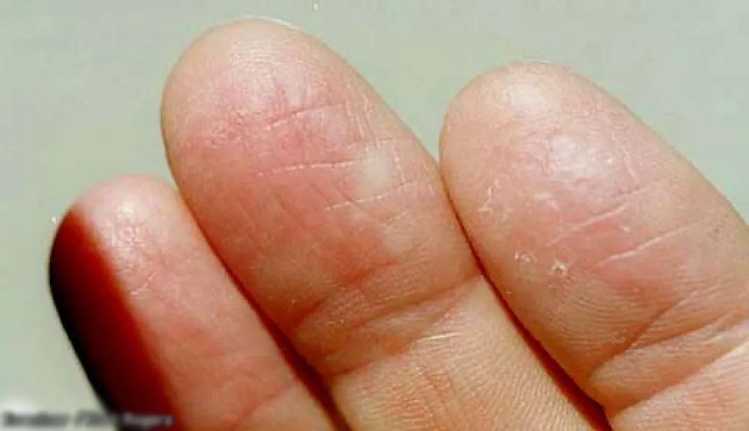 有哪些无指纹的人,没有指纹的人有什么缺点