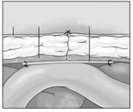 一招根除可复性疝气,疝气手术怎么做不复发