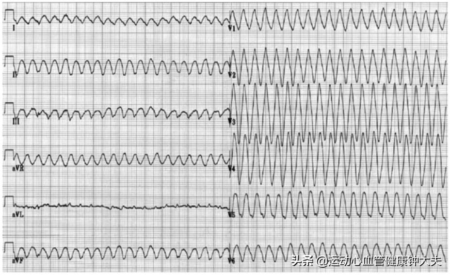 经常运动的人会不会心肌梗死,经常运动的人会得脑梗心梗吗