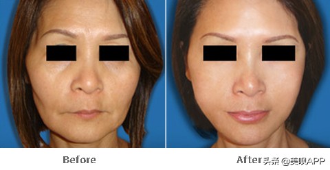 不做医美真的会快速衰老吗,为什么医美使得皮肤衰老更快