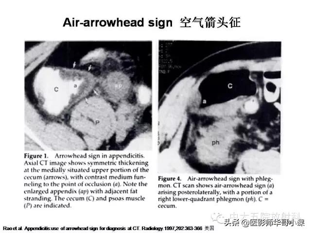 阑尾炎课件,阑尾炎的超声课件