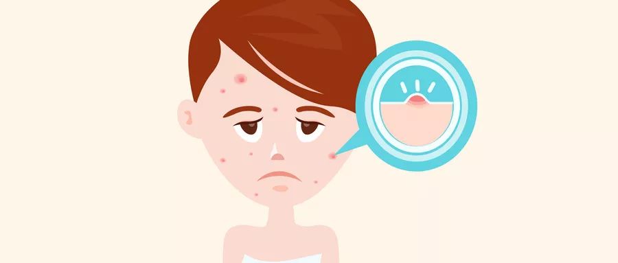 痘痘怎么治最快最有效的方法,痘痘怎么治疗最快有效