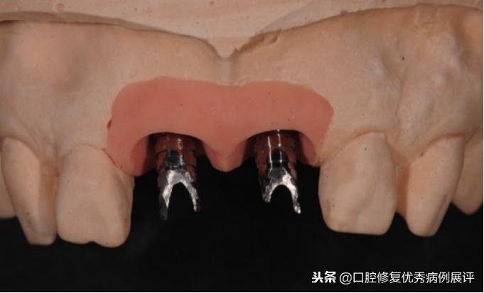 展评优秀病例赏析|Asc全瓷角度基台一体冠进行种植前牙美学修复