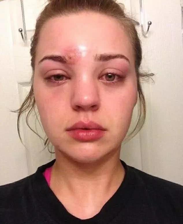 大惊失色!挤完痘痘这样做，很有可能会导致失明，甚至踏上黄泉路