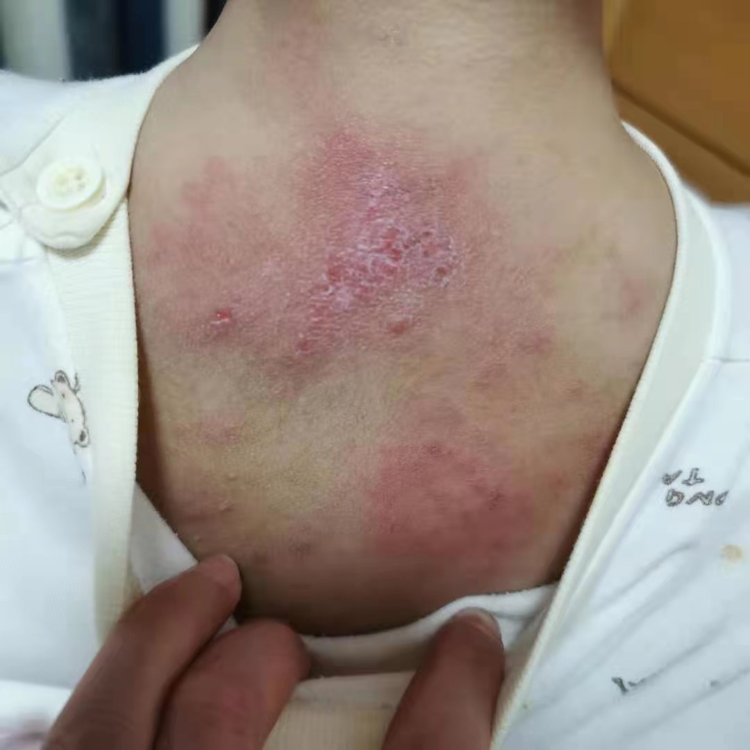 传染性软疣儿童怎么治可以断根,儿童脸上长了传染性软疣怎么办