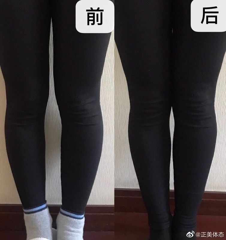 两腿并拢大腿有缝隙怎么练改善,双腿并拢时大腿处有缝隙怎么办