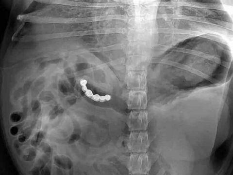 不作死就不会死,看看这些被人类搞进身体里的异物