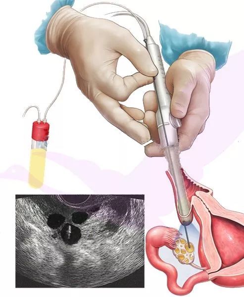 女孩*市黑**卖卵赚钱？身体的疼，还不是最可怕的