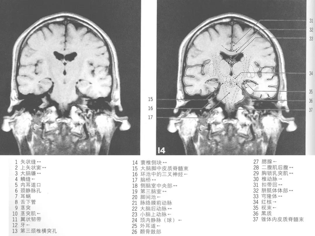 颅脑冠状状切面解剖图,颅脑mr解剖结构图