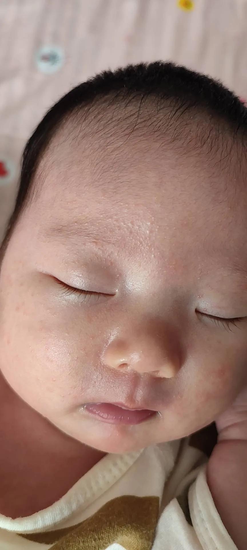 根治湿疹特效药,宝宝湿疹大作战图文