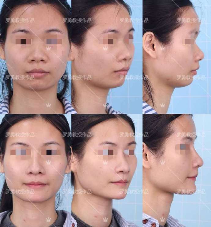 那些隆胸成功的人,那些隆鼻过的女人现在都怎么样了