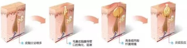 去除又黑又硬的黑头的方法,怎么祛除黑头的最有效方法