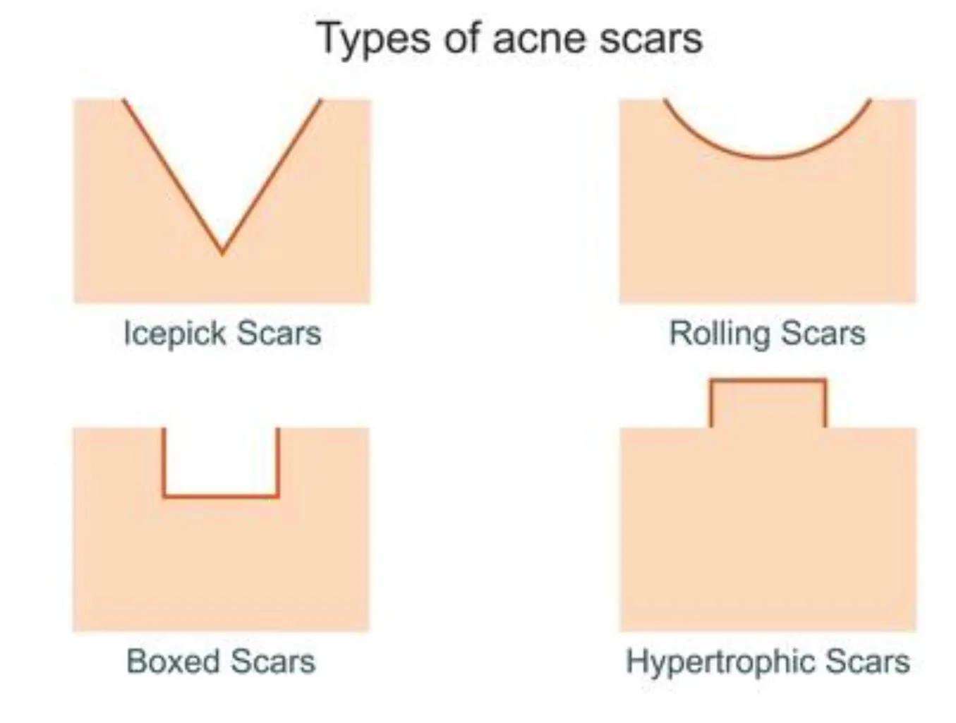 面部生疮后的瘢痕怎么办,疮疤去除