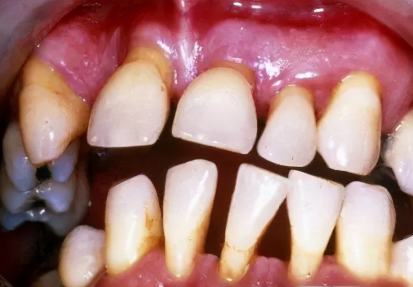 预防牙龈出血的牙膏,牙龈出血该怎么预防