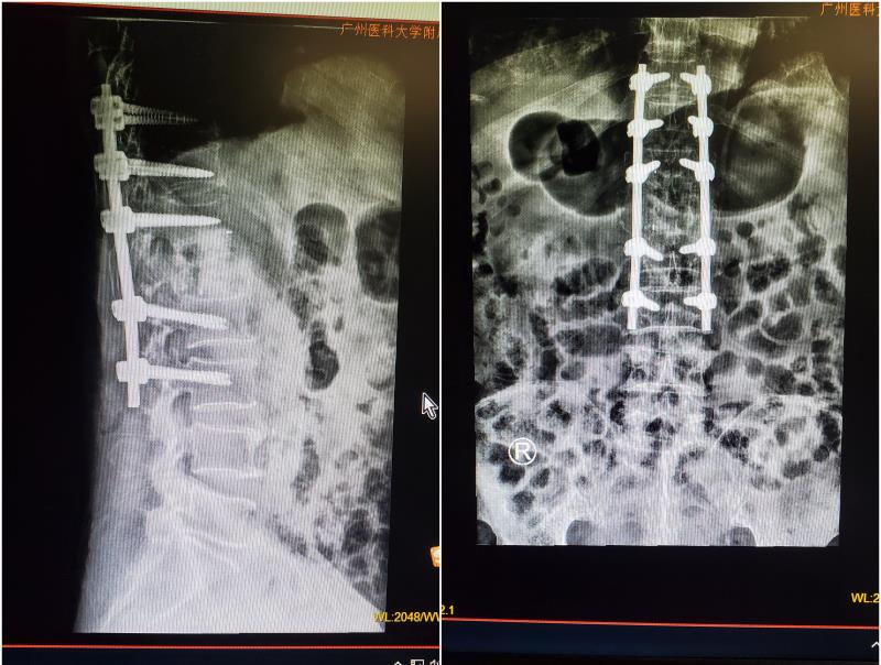 老人腰痛要警惕,老人腰痛没好转要警惕